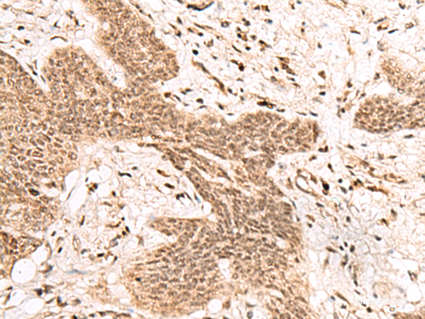 Immunohistochemistry of paraffin-embedded Human esophagus cancer tissue using FAM111B Polyclonal Antibody at dilution of 1:50(×200)