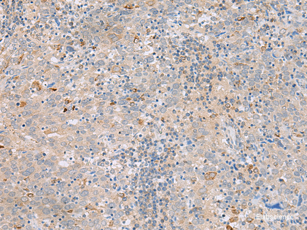 Immunohistochemistry of paraffin-embedded Human cervical cancer tissue using SAXO2 Polyclonal Antibody at dilution of 1:45(×200)