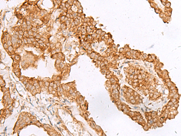 Immunohistochemistry of paraffin-embedded Human thyroid cancer tissue using FAM200A Polyclonal Antibody at dilution of 1:45(×200)