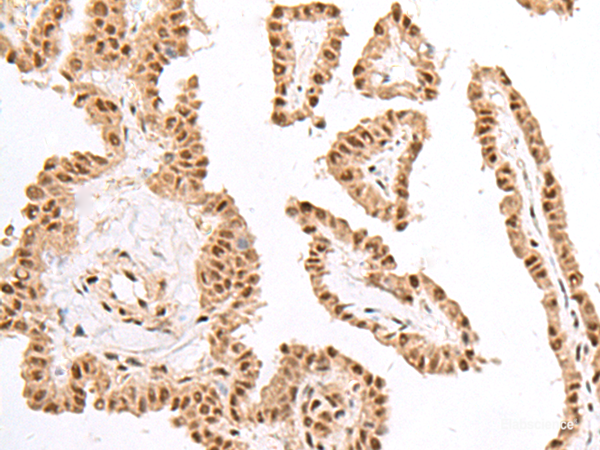 Immunohistochemistry of paraffin-embedded Human thyroid cancer tissue using KDM2A Polyclonal Antibody at dilution of 1:60(×200)