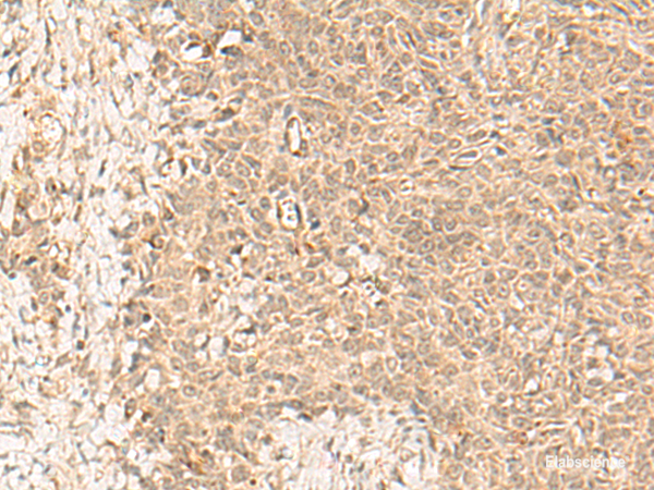 Immunohistochemistry of paraffin-embedded Human ovarian cancer tissue using FBXL4 Polyclonal Antibody at dilution of 1:25(×200)