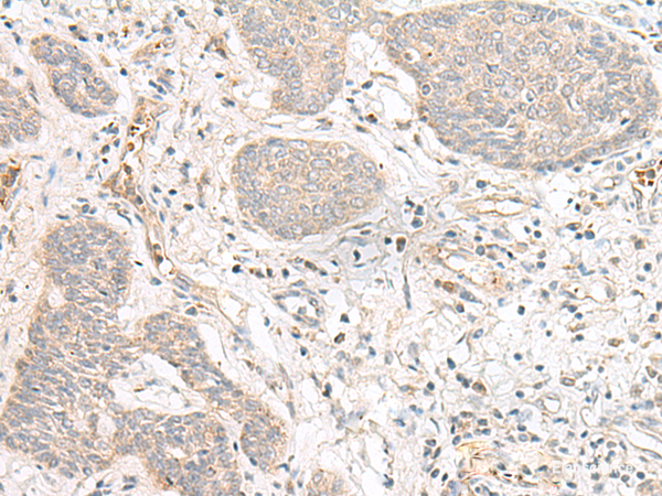 Immunohistochemistry of paraffin-embedded Human esophagus cancer tissue using FBXW8 Polyclonal Antibody at dilution of 1:70(×200)