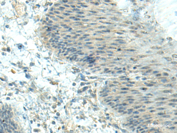 Immunohistochemistry of paraffin-embedded Human esophagus cancer tissue using CTDP1 Polyclonal Antibody at dilution of 1:70(×200)