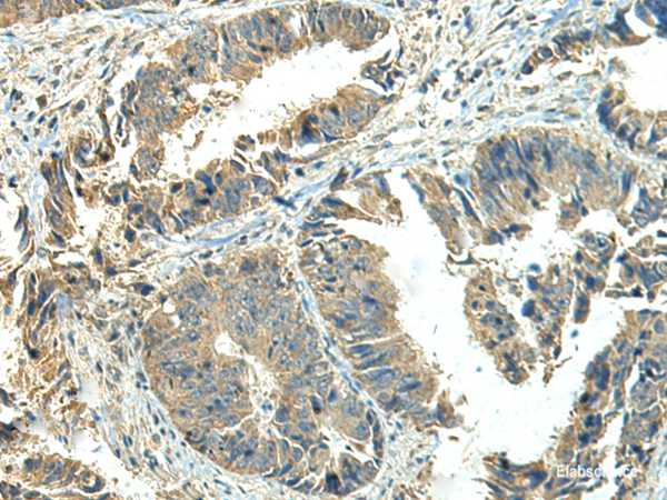 Immunohistochemistry of paraffin-embedded Human colorectal cancer tissue using NPVF Polyclonal Antibody at dilution of 1:65(×200)