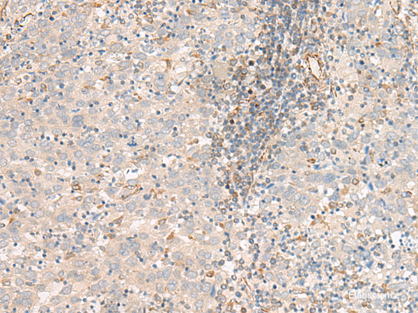 Immunohistochemistry of paraffin-embedded Human cervical cancer tissue using FER Polyclonal Antibody at dilution of 1:80(×200)