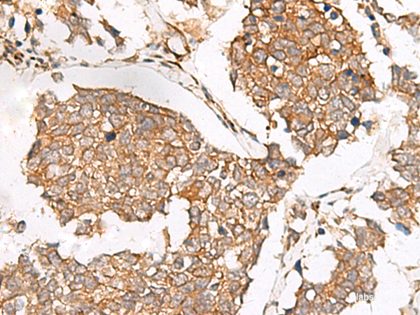 Immunohistochemistry of paraffin-embedded Human lung cancer tissue using SLC40A1 Polyclonal Antibody at dilution of 1:65(×200)