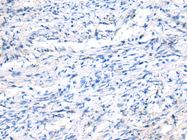Immunohistochemistry of paraffin-embedded Human ovarian cancer tissue using FGF11 Polyclonal Antibody at dilution of 1:50(×200)