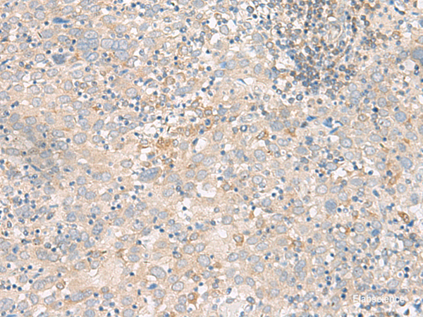 Immunohistochemistry of paraffin-embedded Human cervical cancer tissue using FGF13 Polyclonal Antibody at dilution of 1:45(×200)