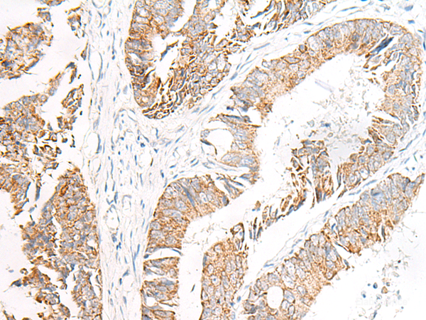 Immunohistochemistry of paraffin-embedded Human colorectal cancer tissue using FGR Polyclonal Antibody at dilution of 1:70(×200)