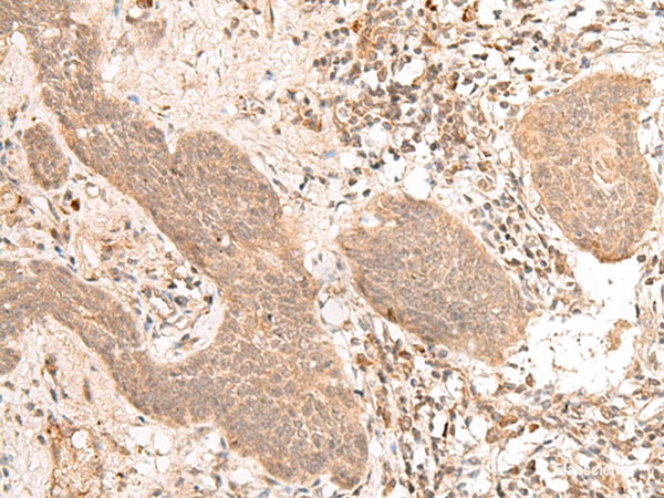 Immunohistochemistry of paraffin-embedded Human esophagus cancer tissue using FIZ1 Polyclonal Antibody at dilution of 1:40(×200)