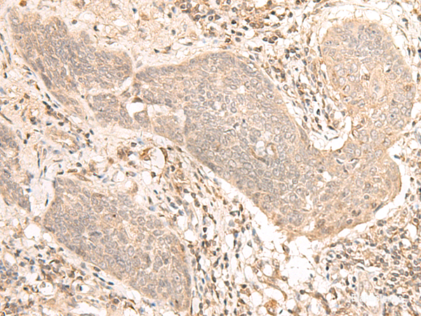Immunohistochemistry of paraffin-embedded Human esophagus cancer tissue using VPS50 Polyclonal Antibody at dilution of 1:30(×200)