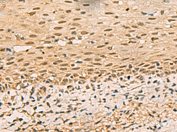 Immunohistochemistry of paraffin-embedded Human cervical cancer tissue using FOXH1 Polyclonal Antibody at dilution of 1:40(×200)
