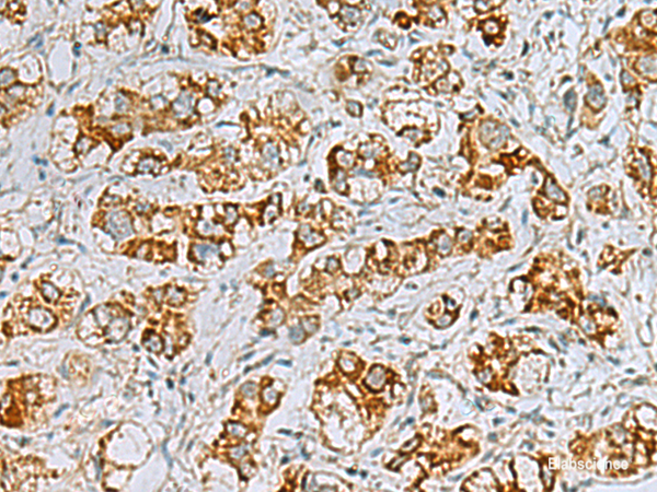 Immunohistochemistry of paraffin-embedded Human liver cancer tissue using FAAP100 Polyclonal Antibody at dilution of 1:40(×200)