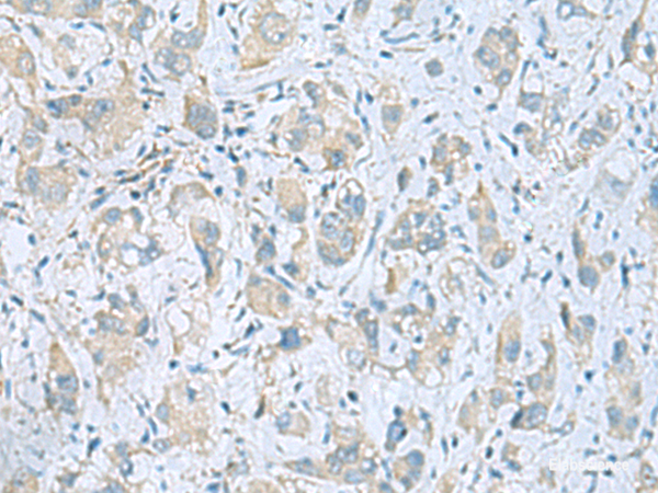 Immunohistochemistry of paraffin-embedded Human liver cancer tissue using PLN Polyclonal Antibody at dilution of 1:45(×200)