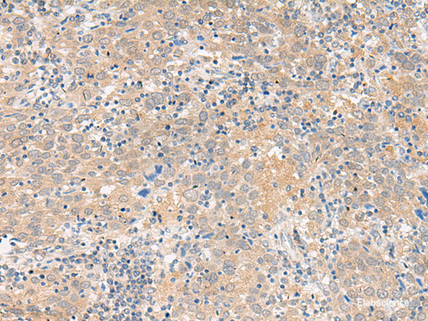 Immunohistochemistry of paraffin-embedded Human cervical cancer tissue using GALP Polyclonal Antibody at dilution of 1:45(×200)