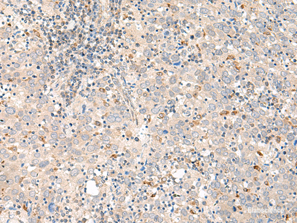 Immunohistochemistry of paraffin-embedded Human cervical cancer tissue using GALR1 Polyclonal Antibody at dilution of 1:60(×200)