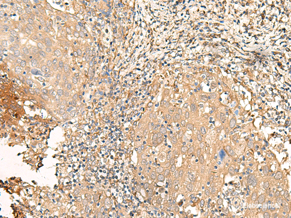 Immunohistochemistry of paraffin-embedded Human cervical cancer tissue using GALR2 Polyclonal Antibody at dilution of 1:25(×200)