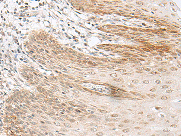 Immunohistochemistry of paraffin-embedded Human esophagus cancer tissue using RALGAPA1 Polyclonal Antibody at dilution of 1:55(×200)