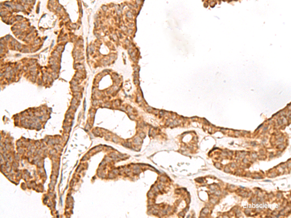 Immunohistochemistry of paraffin-embedded Human thyroid cancer tissue using GBGT1 Polyclonal Antibody at dilution of 1:40(×200)