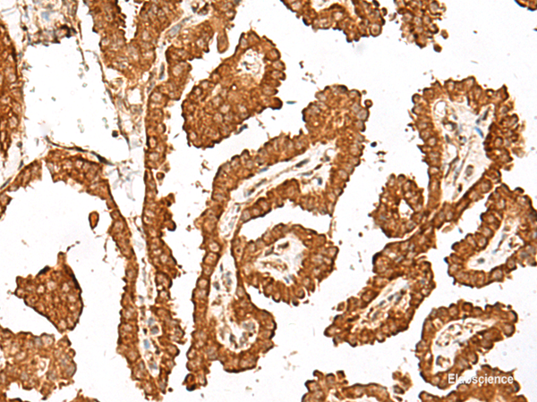 Immunohistochemistry of paraffin-embedded Human thyroid cancer tissue using GBP4 Polyclonal Antibody at dilution of 1:45(×200)