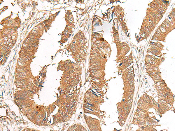 Immunohistochemistry of paraffin-embedded Human colorectal cancer tissue using GCC2 Polyclonal Antibody at dilution of 1:50(×200)