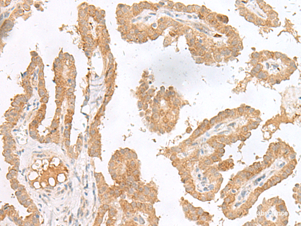 Immunohistochemistry of paraffin-embedded Human thyroid cancer tissue using CXCL6 Polyclonal Antibody at dilution of 1:45(×200)