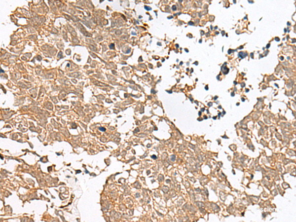 Immunohistochemistry of paraffin-embedded Human lung cancer tissue using GRASP Polyclonal Antibody at dilution of 1:60(×200)
