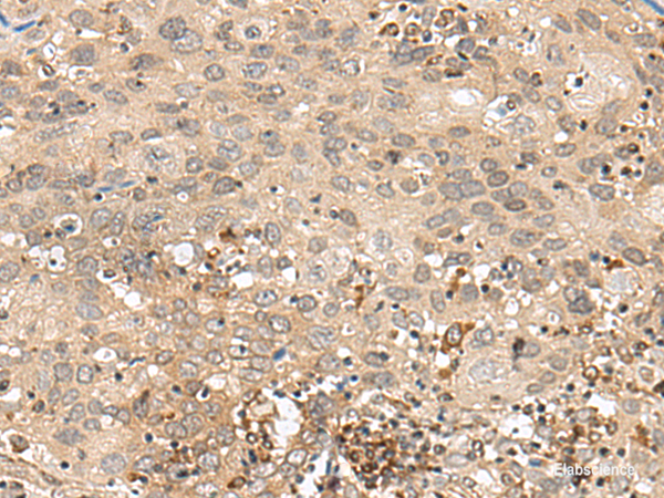 Immunohistochemistry of paraffin-embedded Human cervical cancer tissue using GFI1 Polyclonal Antibody at dilution of 1:60(×200)