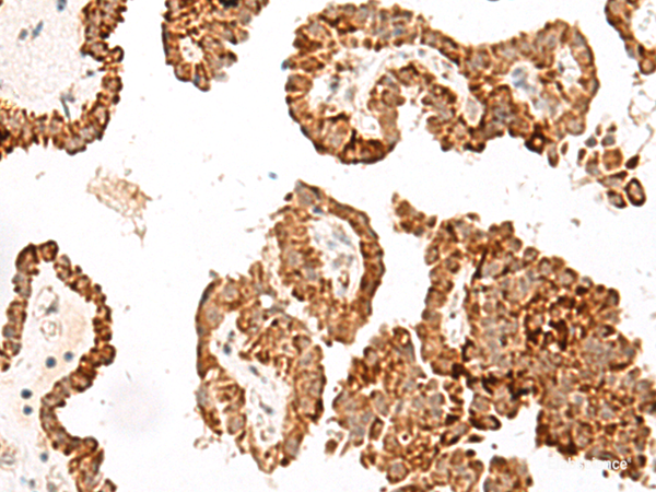 Immunohistochemistry of paraffin-embedded Human thyroid cancer tissue using GFI1B Polyclonal Antibody at dilution of 1:40(×200)