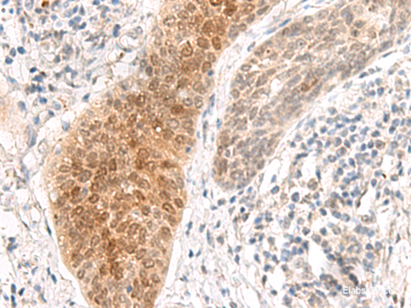 Immunohistochemistry of paraffin-embedded Human esophagus cancer tissue using GHDC Polyclonal Antibody at dilution of 1:90(×200)