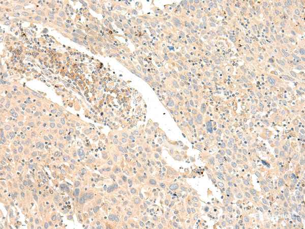 Immunohistochemistry of paraffin-embedded Human cervical cancer tissue using GLIS1 Polyclonal Antibody at dilution of 1:40(×200)