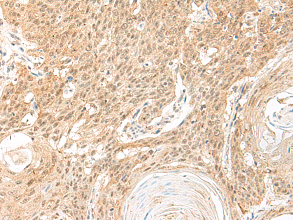 Immunohistochemistry of paraffin-embedded Human esophagus cancer tissue using BICRA Polyclonal Antibody at dilution of 1:60(×200)