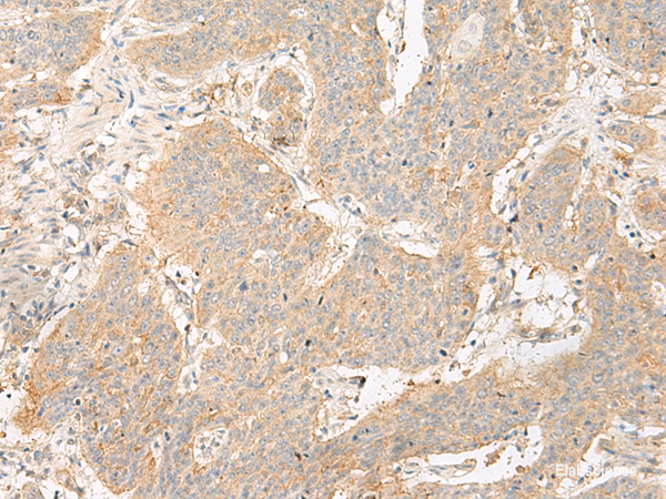 Immunohistochemistry of paraffin-embedded Human esophagus cancer tissue using GP6 Polyclonal Antibody at dilution of 1:40(×200)
