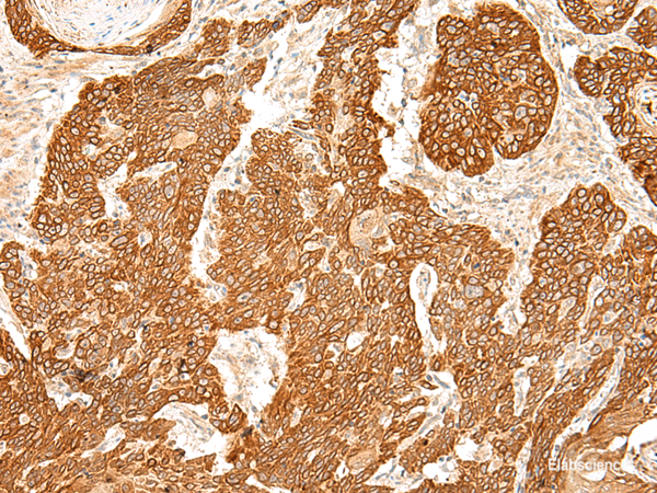 Immunohistochemistry of paraffin-embedded Human esophagus cancer tissue using SLC6A9 Polyclonal Antibody at dilution of 1:50(×200)