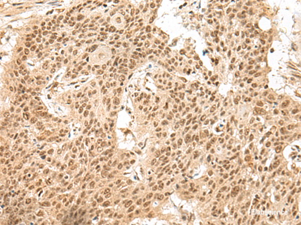 Immunohistochemistry of paraffin-embedded Human esophagus cancer tissue using GMEB2 Polyclonal Antibody at dilution of 1:30(×200)