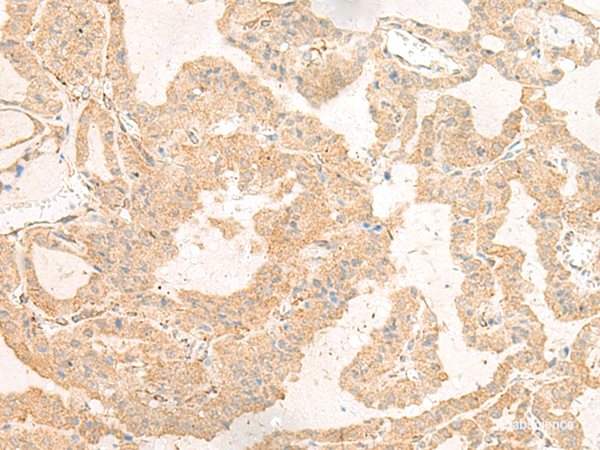 Immunohistochemistry of paraffin-embedded Human thyroid cancer tissue using GNAT3 Polyclonal Antibody at dilution of 1:40(×200)