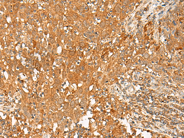 Immunohistochemistry of paraffin-embedded Human cervical cancer tissue using GPR1 Polyclonal Antibody at dilution of 1:50(×200)