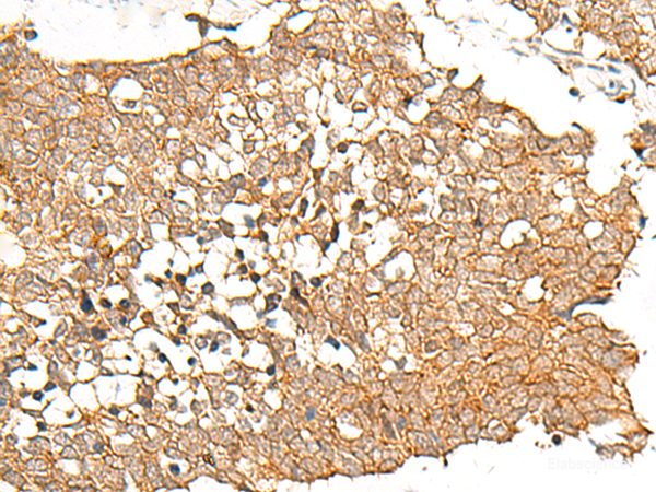 Immunohistochemistry of paraffin-embedded Human lung cancer tissue using PRLHR Polyclonal Antibody at dilution of 1:70(×200)