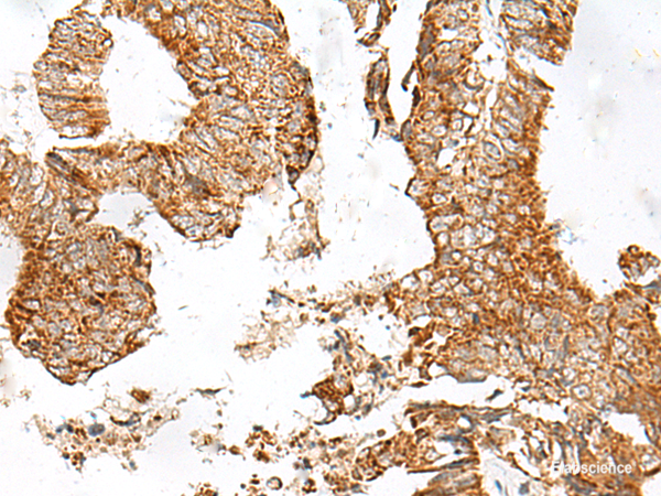 Immunohistochemistry of paraffin-embedded Human colorectal cancer tissue using GPR119 Polyclonal Antibody at dilution of 1:45(×200)