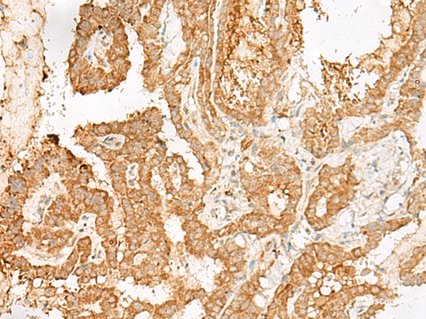 Immunohistochemistry of paraffin-embedded Human thyroid cancer tissue using ADGRF1 Polyclonal Antibody at dilution of 1:25(×200)