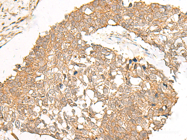 Immunohistochemistry of paraffin-embedded Human lung cancer tissue using POLR2L Polyclonal Antibody at dilution of 1:40(×200)