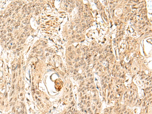 Immunohistochemistry of paraffin-embedded Human esophagus cancer tissue using SNAPC5 Polyclonal Antibody at dilution of 1:30(×200)