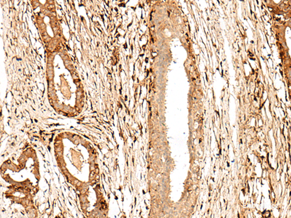 Immunohistochemistry of paraffin-embedded Human breast cancer tissue using GPR27 Polyclonal Antibody at dilution of 1:60(×200)