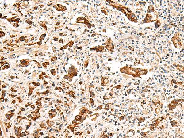 Immunohistochemistry of paraffin-embedded Human prost at e cancer tissue using GPR160 Polyclonal Antibody at dilution of 1:35(×200)