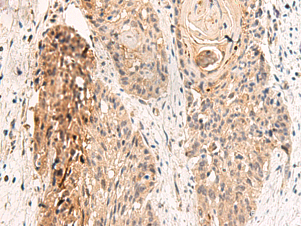 Immunohistochemistry of paraffin-embedded Human esophagus cancer tissue using GPR152 Polyclonal Antibody at dilution of 1:45(×200)