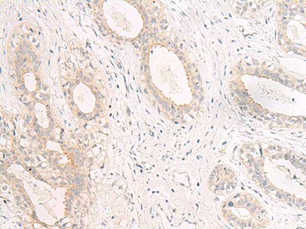 Immunohistochemistry of paraffin-embedded Human breast cancer tissue using GPR157 Polyclonal Antibody at dilution of 1:60(×200)