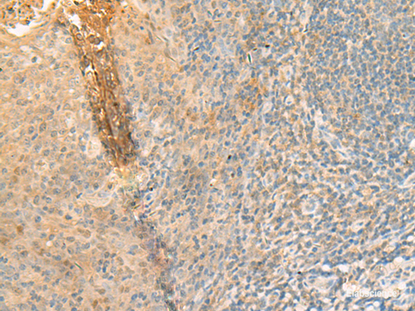 Immunohistochemistry of paraffin-embedded Human tonsil tissue using GPT2 Polyclonal Antibody at dilution of 1:70(×200)