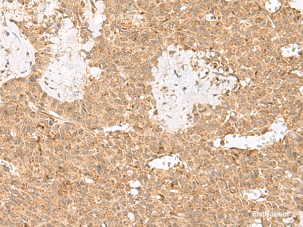 Immunohistochemistry of paraffin-embedded Human ovarian cancer tissue using LGALSL Polyclonal Antibody at dilution of 1:25(×200)