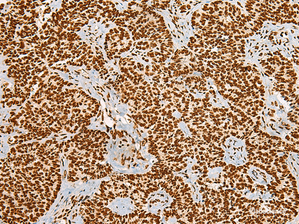 Immunohistochemistry of paraffin-embedded Human ovarian cancer tissue using HABP4 Polyclonal Antibody at dilution of 1:55(×200)