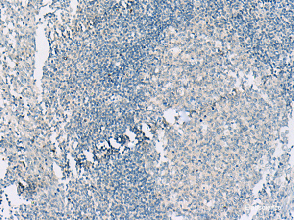 Immunohistochemistry of paraffin-embedded Human tonsil tissue using HASPIN Polyclonal Antibody at dilution of 1:55(×200)